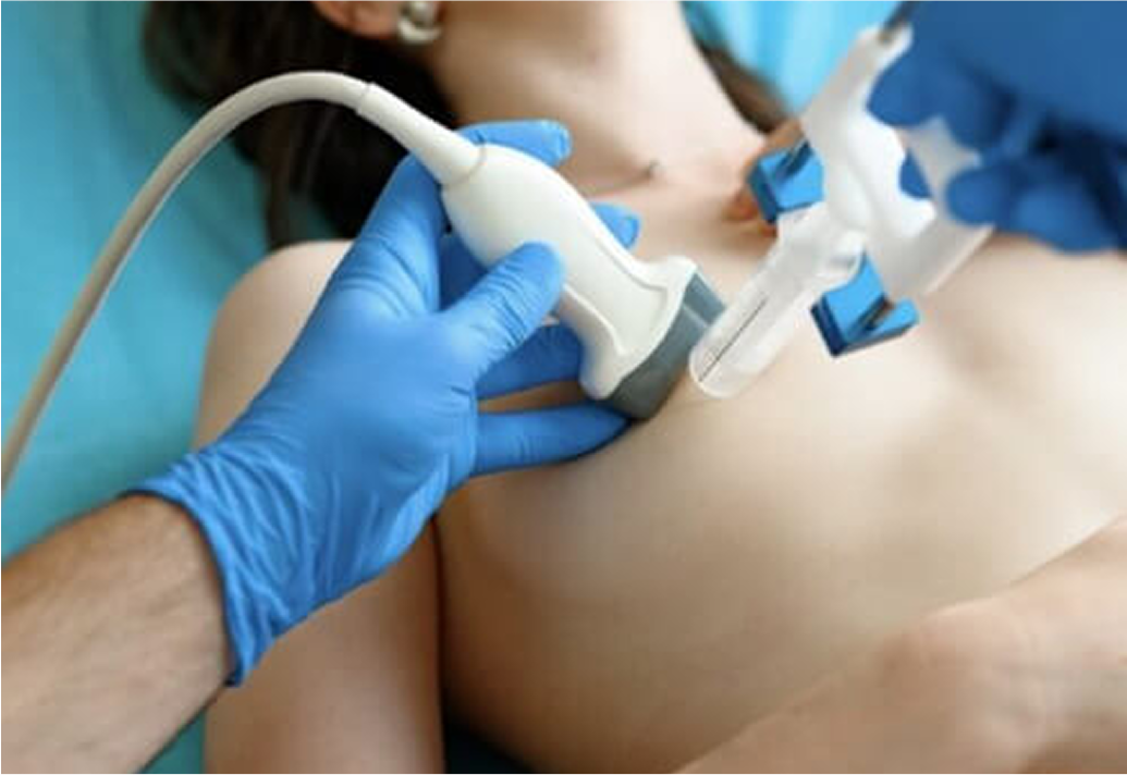 Marcação de nódulo mamário